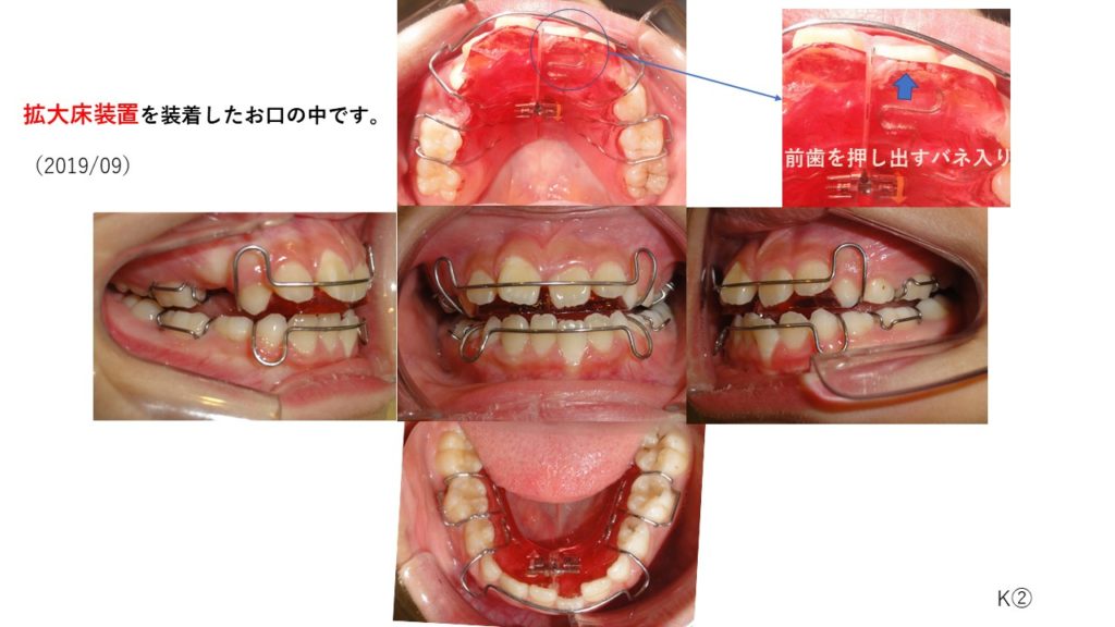 ブログ｜浦和区東岸町の歯科・歯医者ならふみ矯正歯科